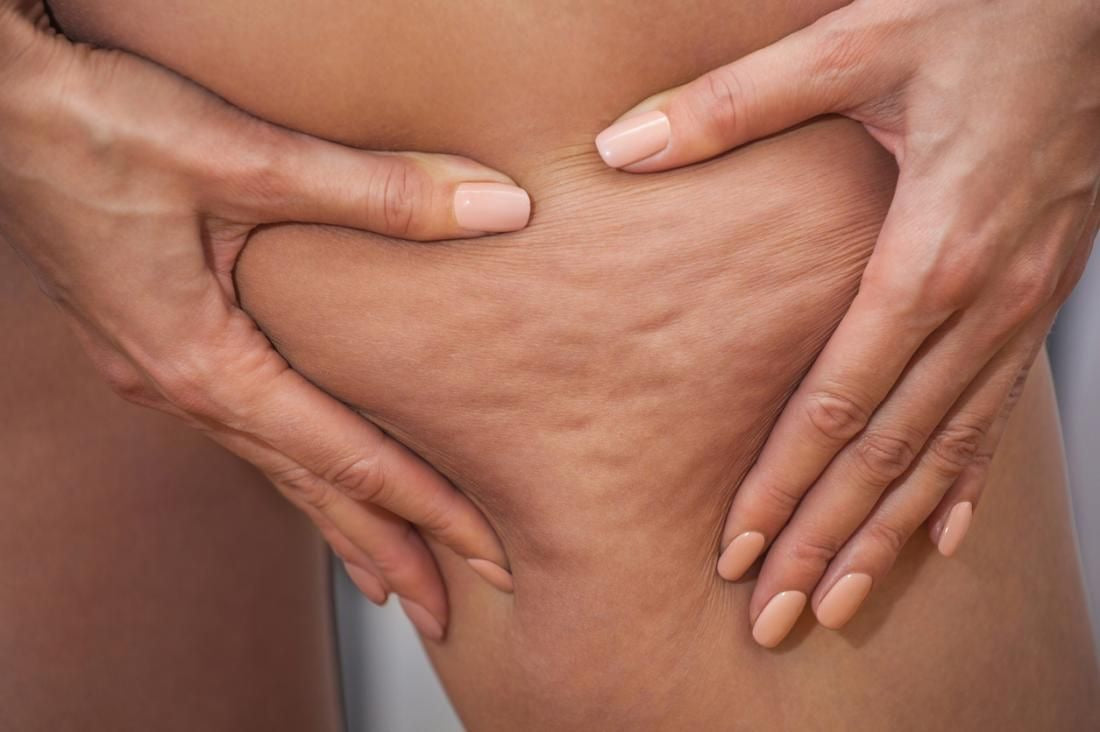 MICRONEEDLING FOCUS CELLULITE